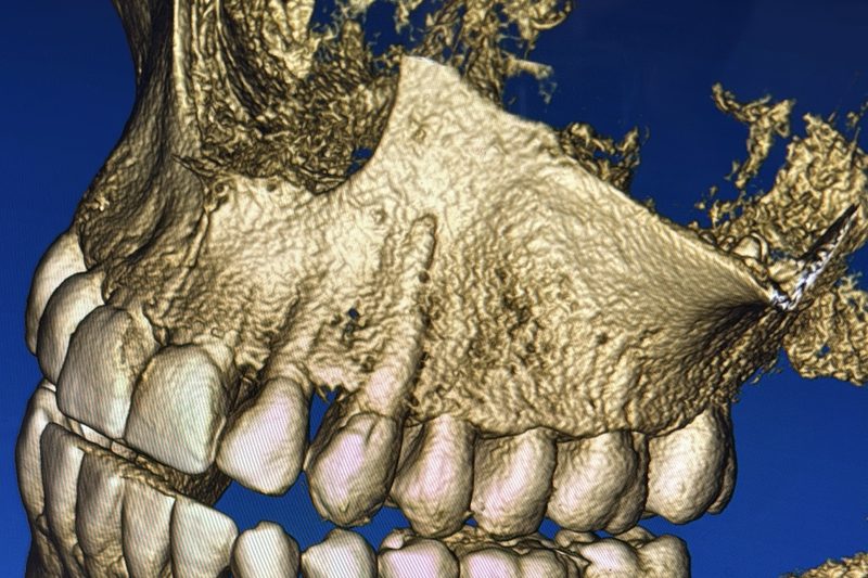 3D-Röntgenbild (DVT) von Ober- und Unterkiefer