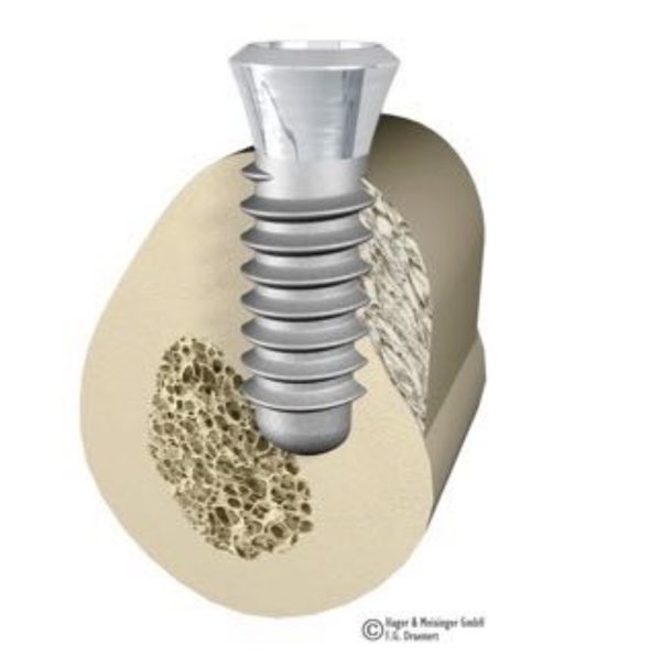 Illustration: Implantat im Kieferknochen im Querschnitt