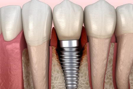 Illustration: Knochenabbau an einem Implantat