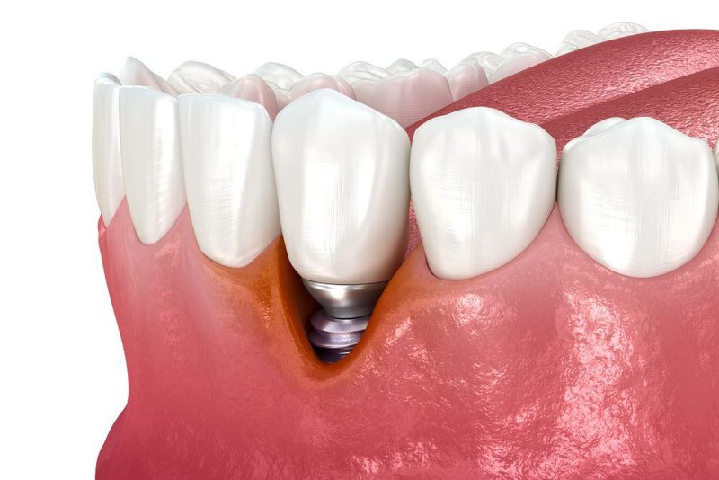 Illustration: entzündetes Zahnfleisch und Knochenabbau an einem Implantat