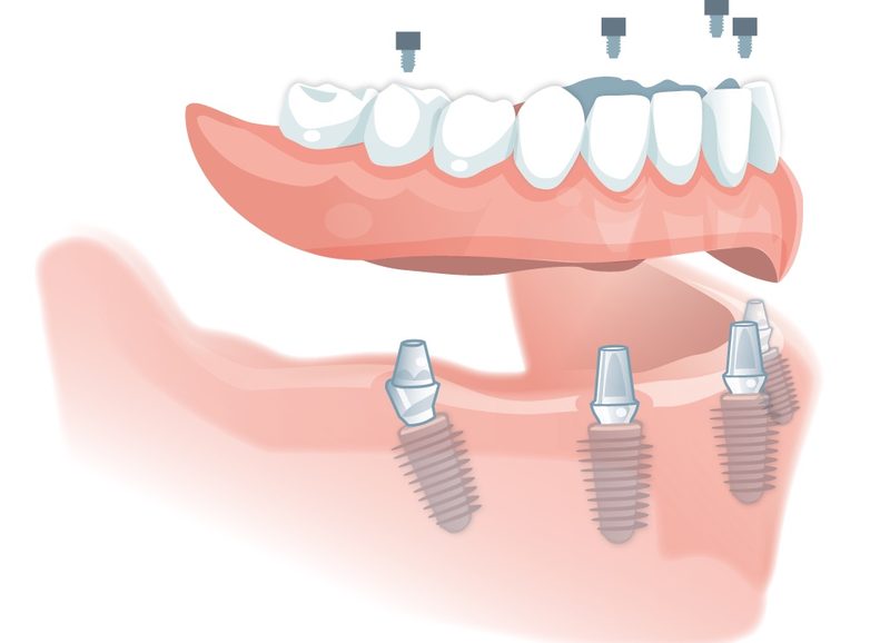 Illustration: festsitzender Zahnersatz auf Implantaten